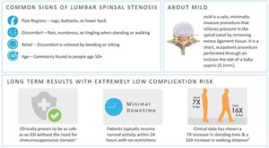 M.I.L.D. procedure for back pain in Mesquite, Frisco and Desoto, TX M.I.L.D. procedure for back pain in Mesquite, Frisco and Desoto, TX