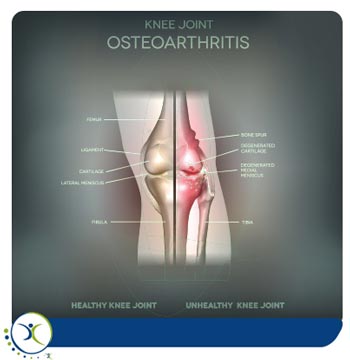 Knee Arthritis Specialist in Dallas and Frisco TX Knee Arthritis Specialist in Dallas and Frisco TX