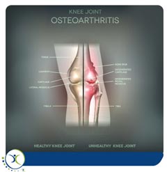 Knee Arthritis Specialist in Dallas and Frisco TX Knee Arthritis Specialist in Dallas and Frisco TX